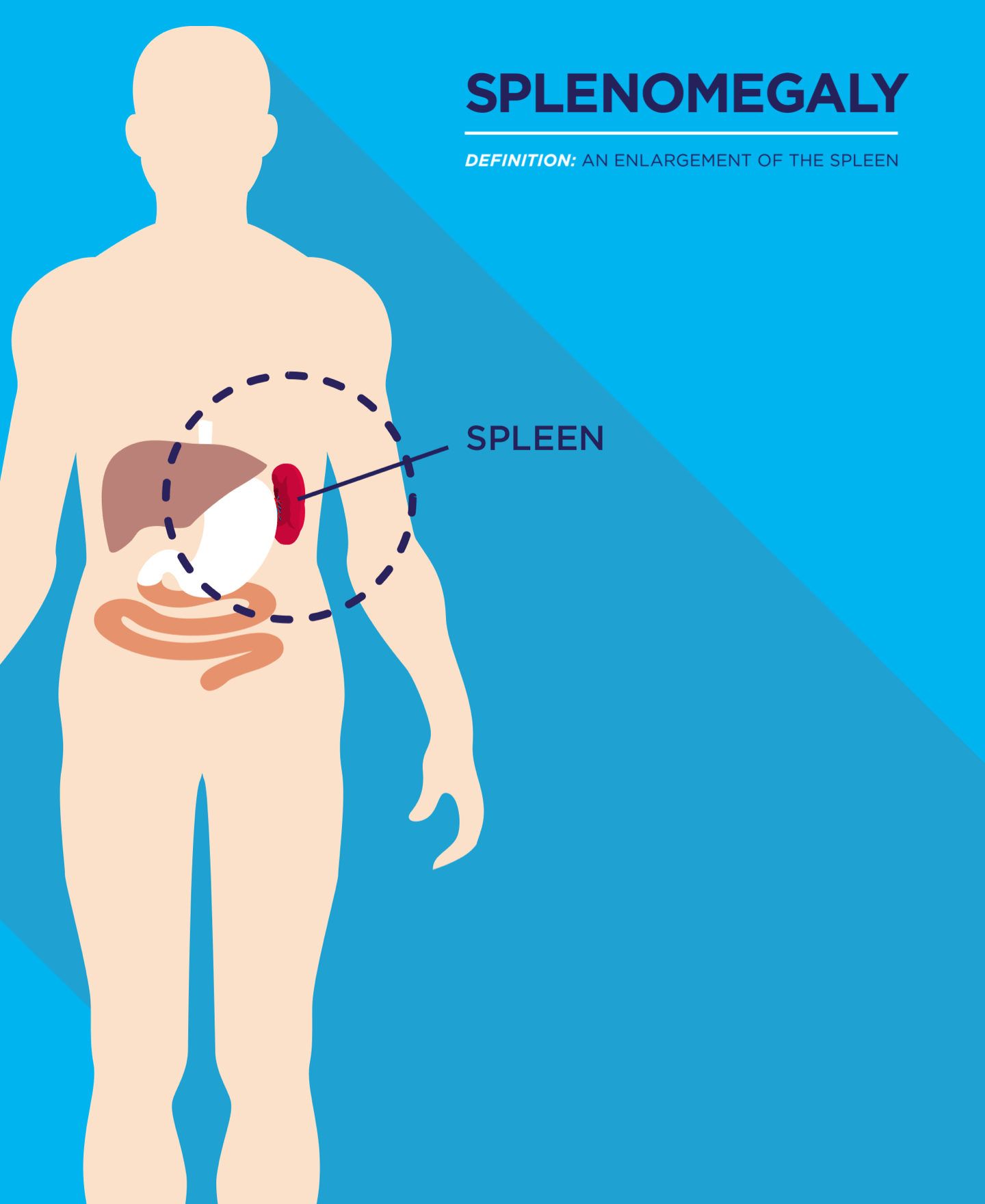 What Every Patient With an MPN Should Know About the Spleen